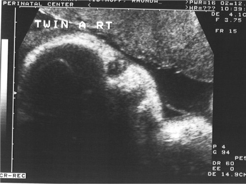 Jenna's ultrasound picture