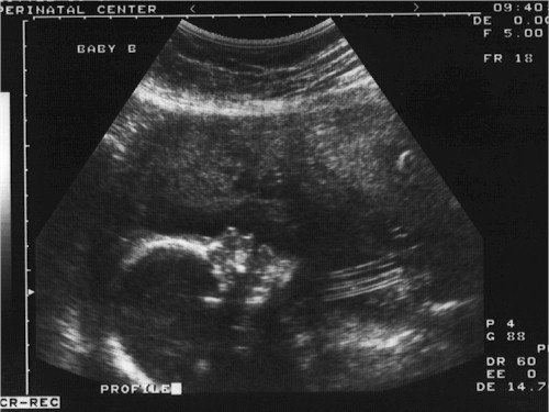Laina's ultrasound picture
