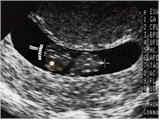 Austin's ultrasound picture